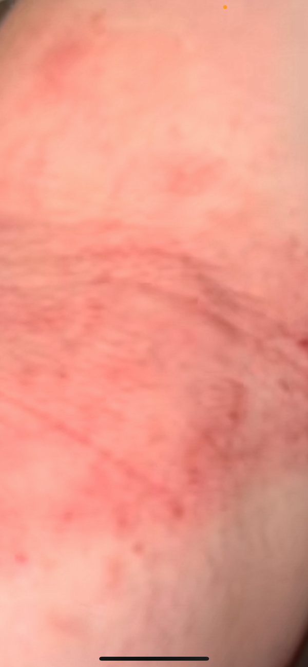 Fin de l'eczéma. Installation 2min top chrono.
